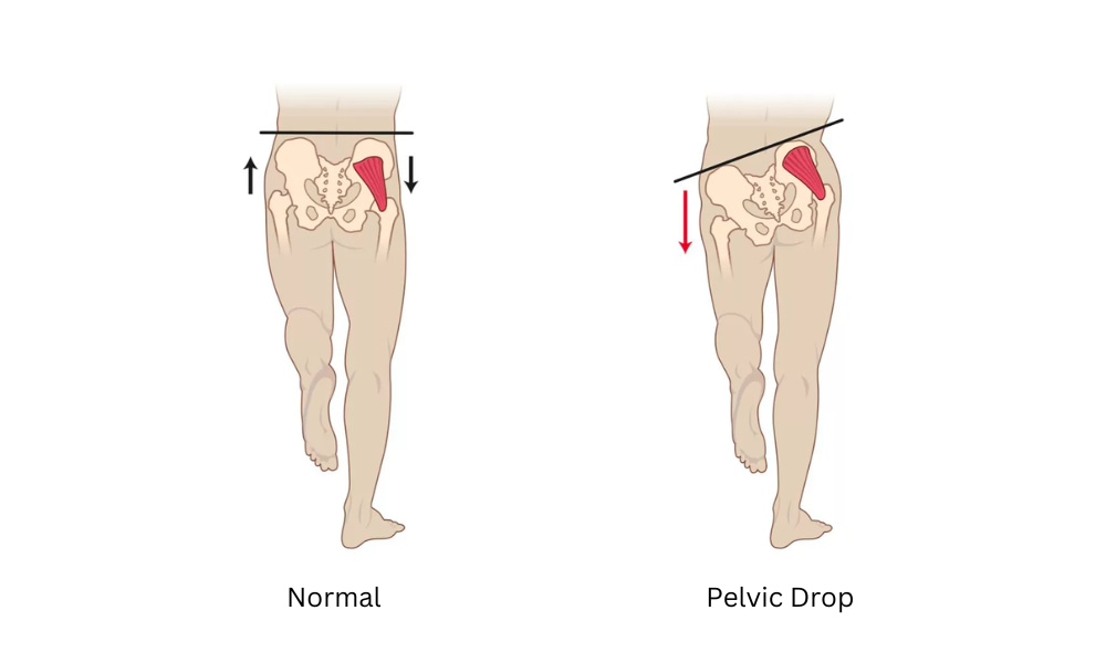 Running Causes Back Pain due to pelvic drop