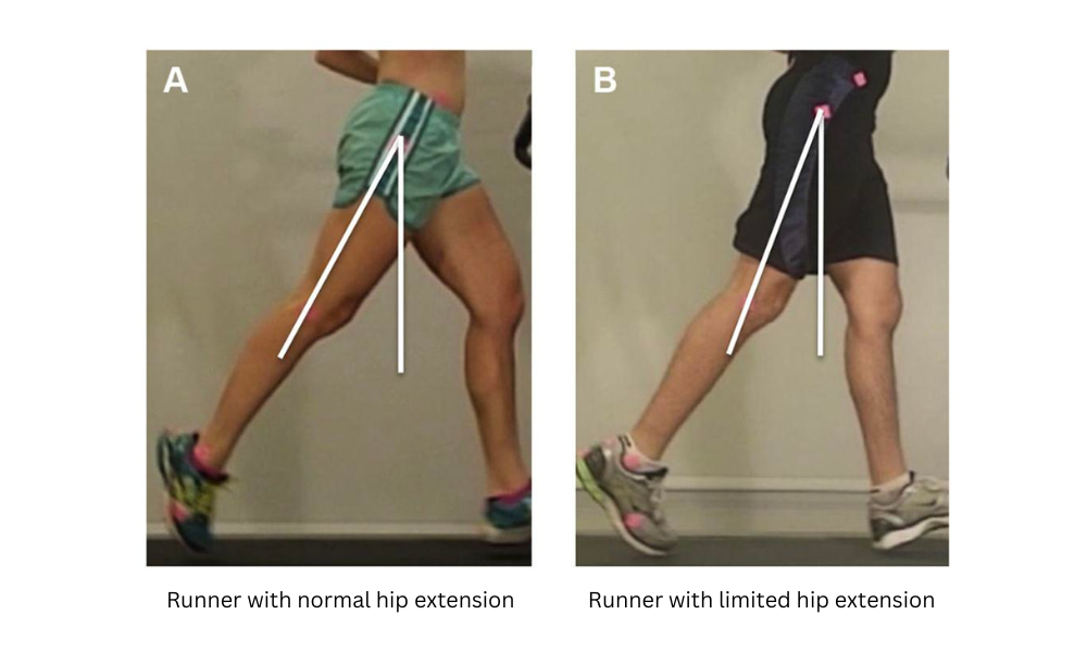 Running Causes Back Pain due to limited hip extension