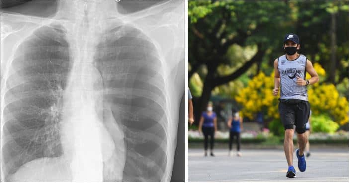 Jogger’s Lung Collapses After Running With Face Mask