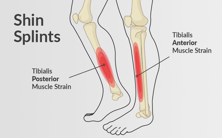 Tips to Prevent Shin Splints